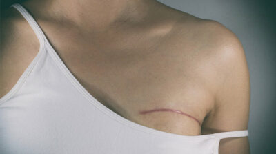 Image of common scars on women